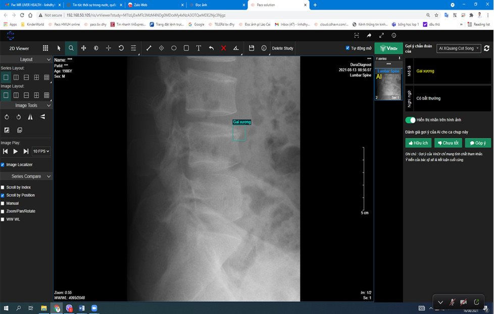 Hình ảnh hệ thống AI-VinDr chẩn đoán 1 người bệnh có gai xương do thoái hóa bờ thân đốt sống L4.