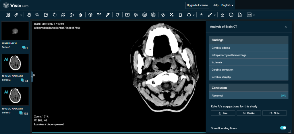 Mô hình AI của VinDr tự động chẩn đoán hình ảnh CT sọ não, với độ chính xác 82%