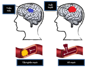 Tiềm năng phòng và điều trị bệnh đột quỵ của Cordycepin