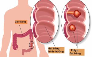 Tiềm năng của ứng dụng trí tuệ nhân tạo trong hỗ trợ phát hiện Polyp đại tràng qua nội soi
